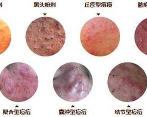 福州医院治青春痘痤疮的六大症状类型